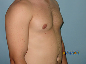 Male Breast Reduction - Gynecomastia