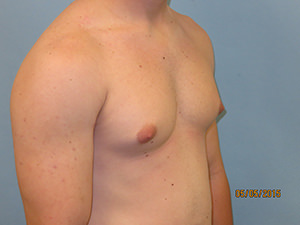 Male Breast Reduction - Gynecomastia