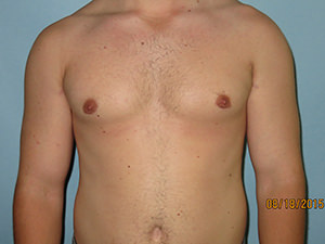 Male Breast Reduction - Gynecomastia