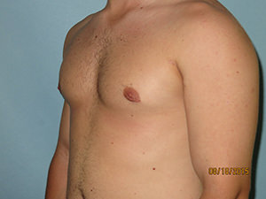 Male Breast Reduction - Gynecomastia