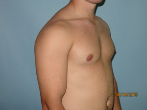 Male Breast Reduction - Gynecomastia