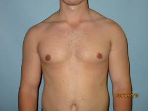 Male Breast Reduction - Gynecomastia