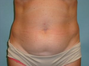 Tummy Tuck