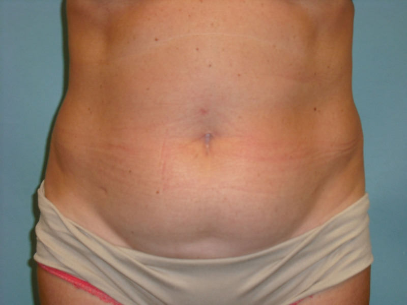 Tummy Tuck