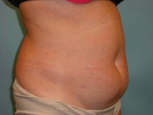 Tummy Tuck