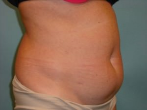 Tummy Tuck