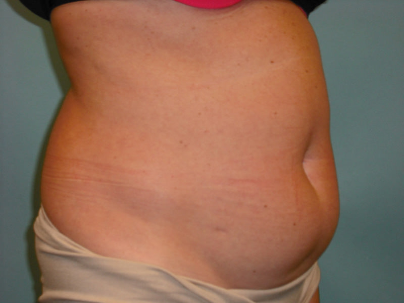 Tummy Tuck