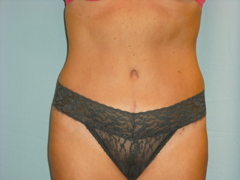 Tummy Tuck