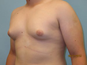 Male Breast Reduction - Gynecomastia