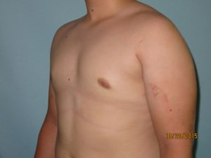 Male Breast Reduction - Gynecomastia