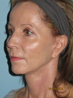 Facelift