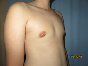 Male Breast Reduction - Gynecomastia