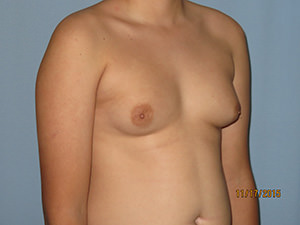 Male Breast Reduction - Gynecomastia