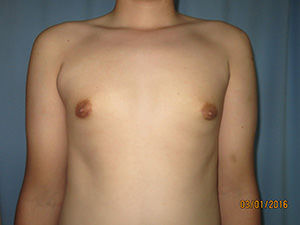 Male Breast Reduction - Gynecomastia