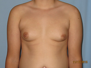 Male Breast Reduction - Gynecomastia