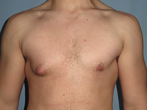 Male Breast Reduction - Gynecomastia