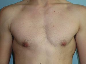 Male Breast Reduction - Gynecomastia