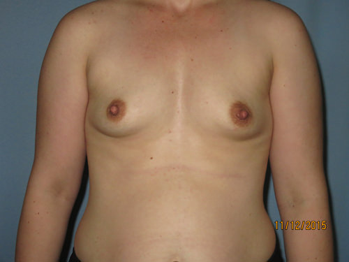 Breast Augmentation