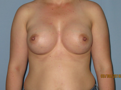 Breast Augmentation