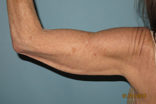 Brachioplasty (Arm Lift)