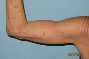 Brachioplasty (Arm Lift)