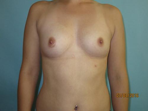 Breast Augmentation