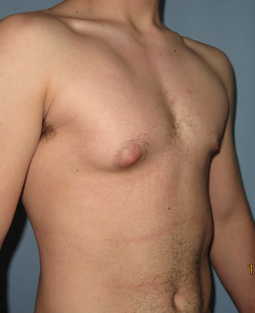 Male Breast Reduction - Gynecomastia