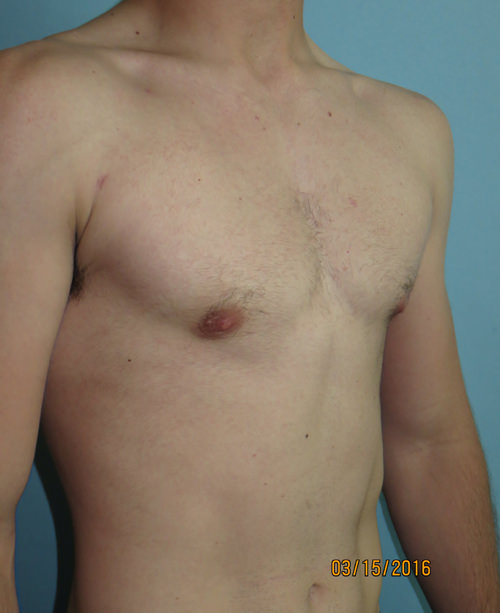 Male Breast Reduction - Gynecomastia