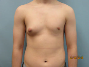 Male Breast Reduction - Gynecomastia