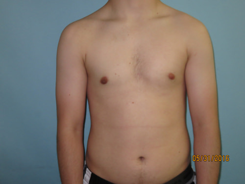 Male Breast Reduction - Gynecomastia