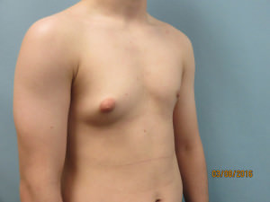 Male Breast Reduction - Gynecomastia