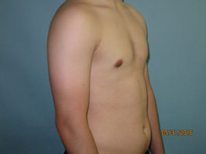 Male Breast Reduction - Gynecomastia