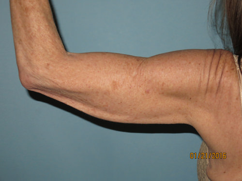 Brachioplasty (Arm Lift)