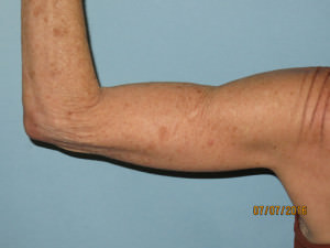 Brachioplasty (Arm Lift)