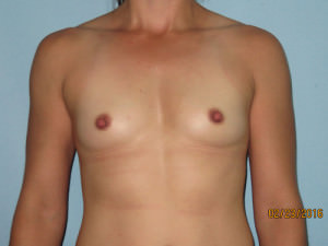 Breast Augmentation