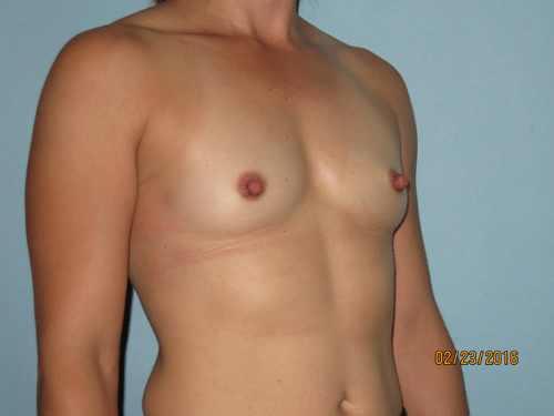 Breast Augmentation