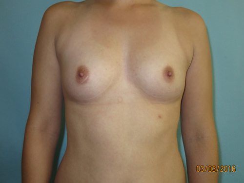 Breast Augmentation