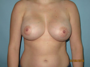 Breast Augmentation