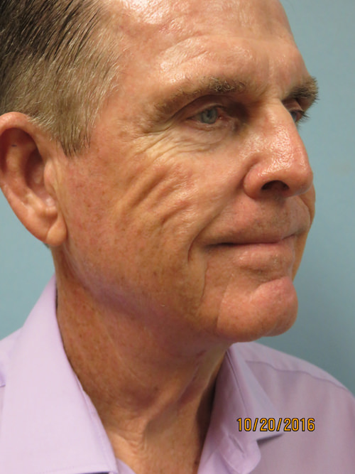 Neck Lift: Men