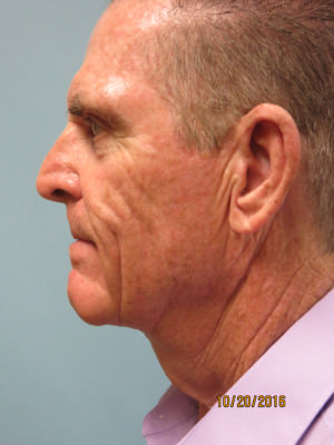 Neck Lift: Men
