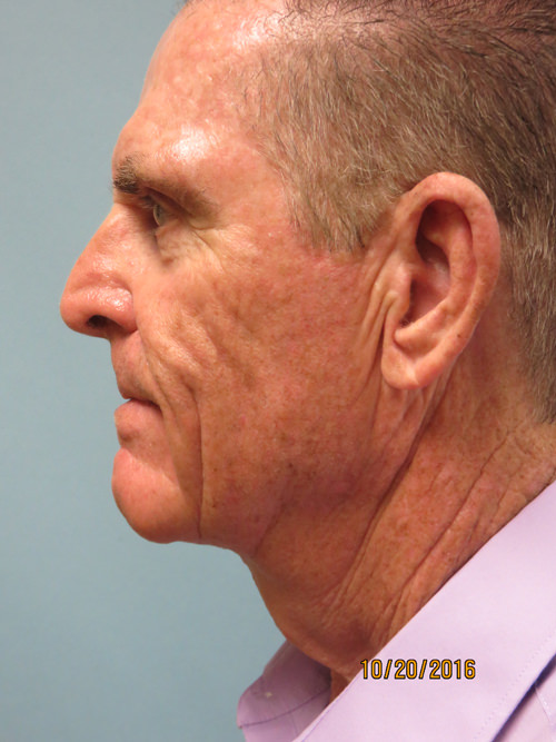Neck Lift: Men