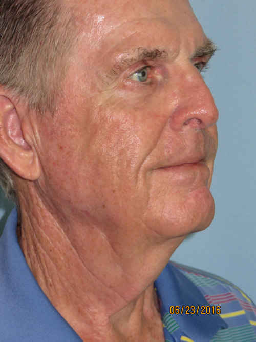 Neck Lift: Men