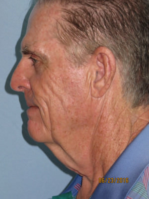 Neck Lift: Men