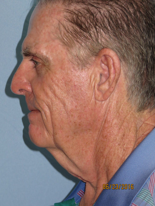 Neck Lift: Men