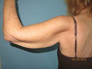 Brachioplasty (Arm Lift)