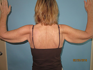 Brachioplasty (Arm Lift)