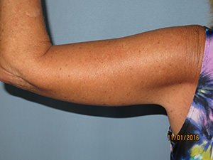 Brachioplasty (Arm Lift)