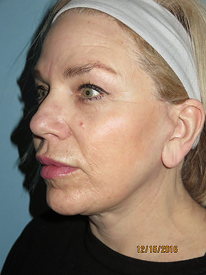 Facelift