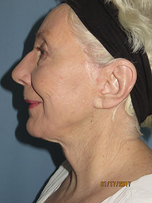 Facelift