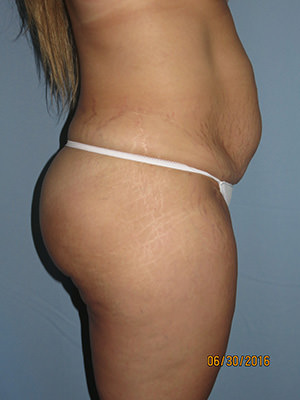 Tummy Tuck